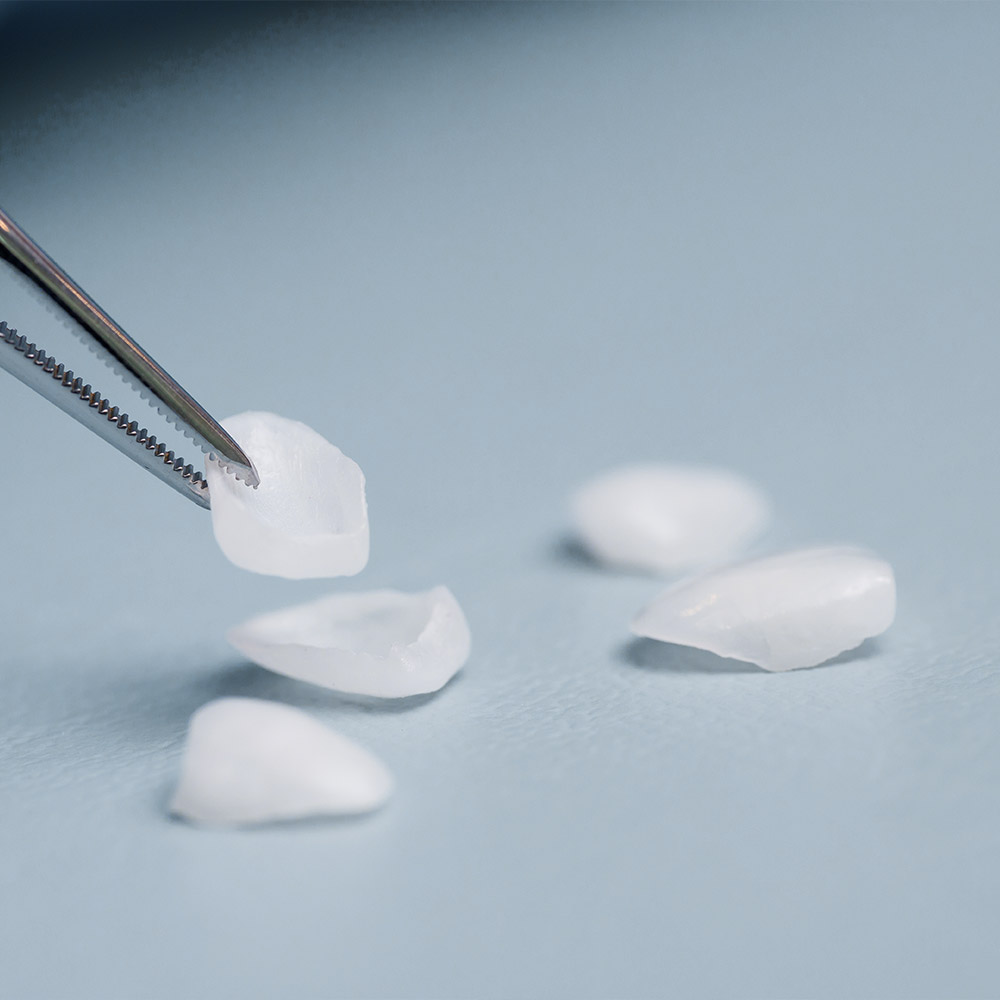Abbilung von Veneers vor dem Einsatz